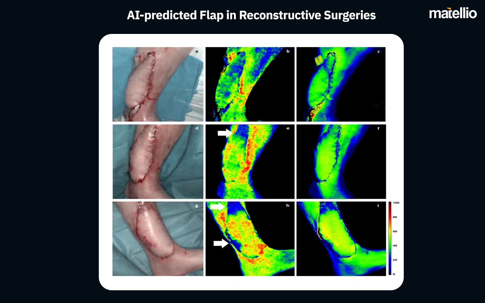 AI-predicted Flap in Reconstructive Surgeries