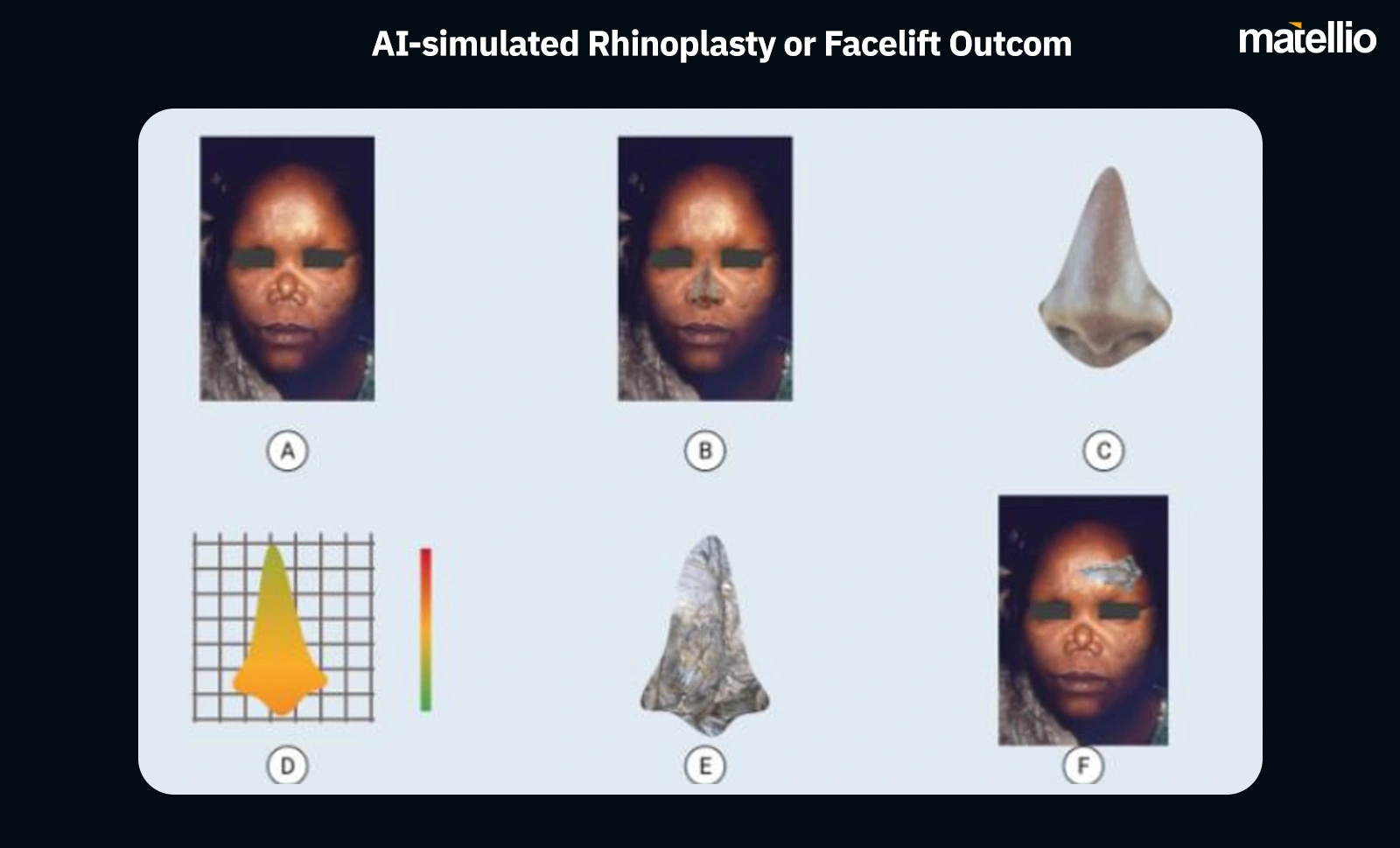 AI-simulated Rhinoplasty or Facelift Outcome