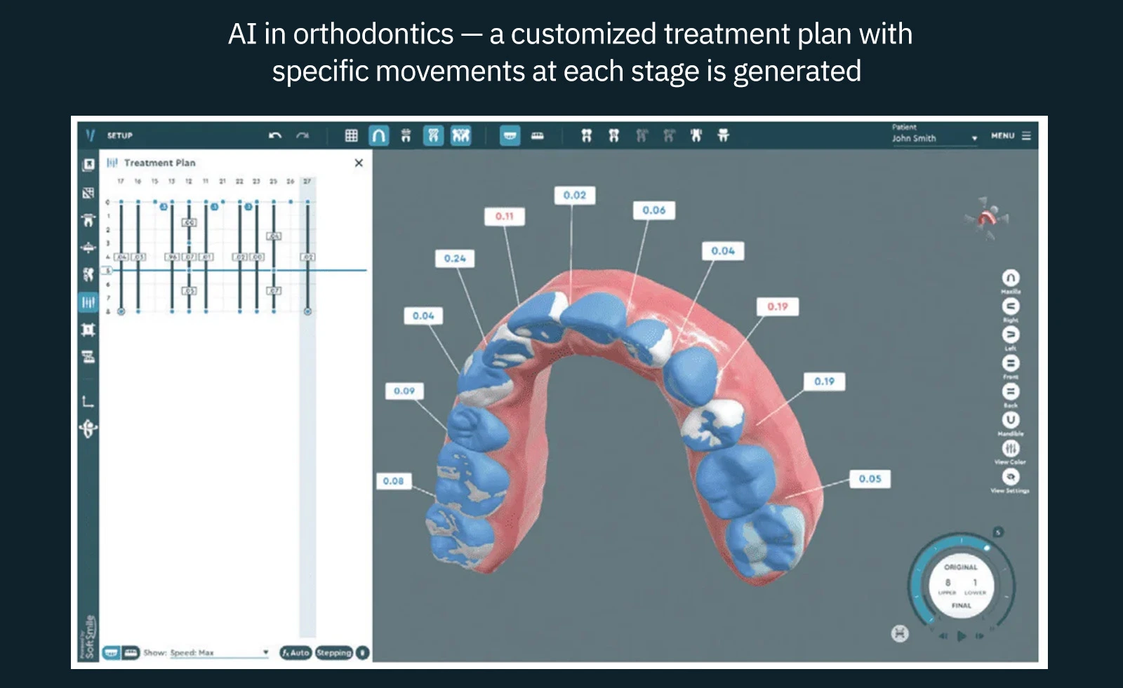 AI in orthodontics — a customized treatment plan with specific movements at each stage is generated
