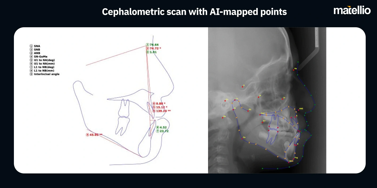 Cephalometric scan with AI-mapped points 