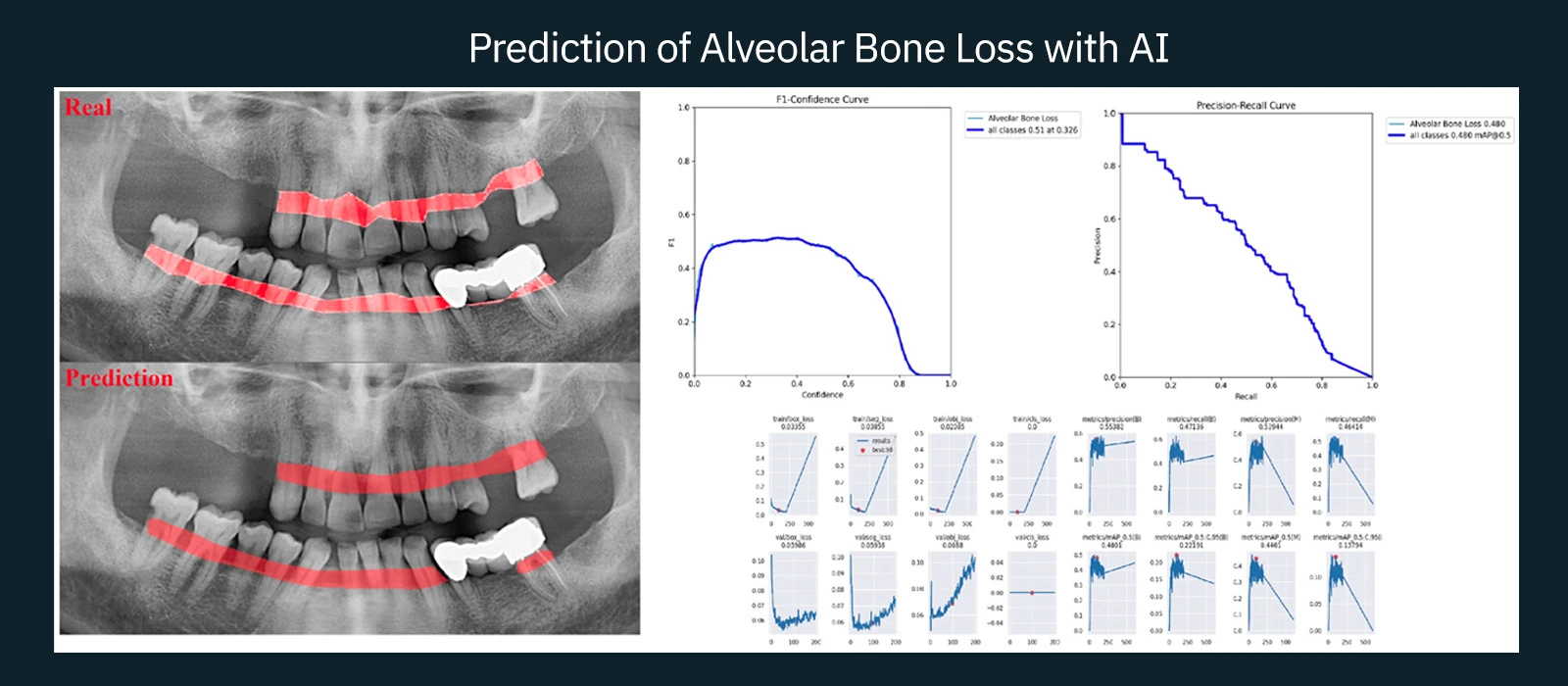Prediction of Alveolar Bone Loss with AI