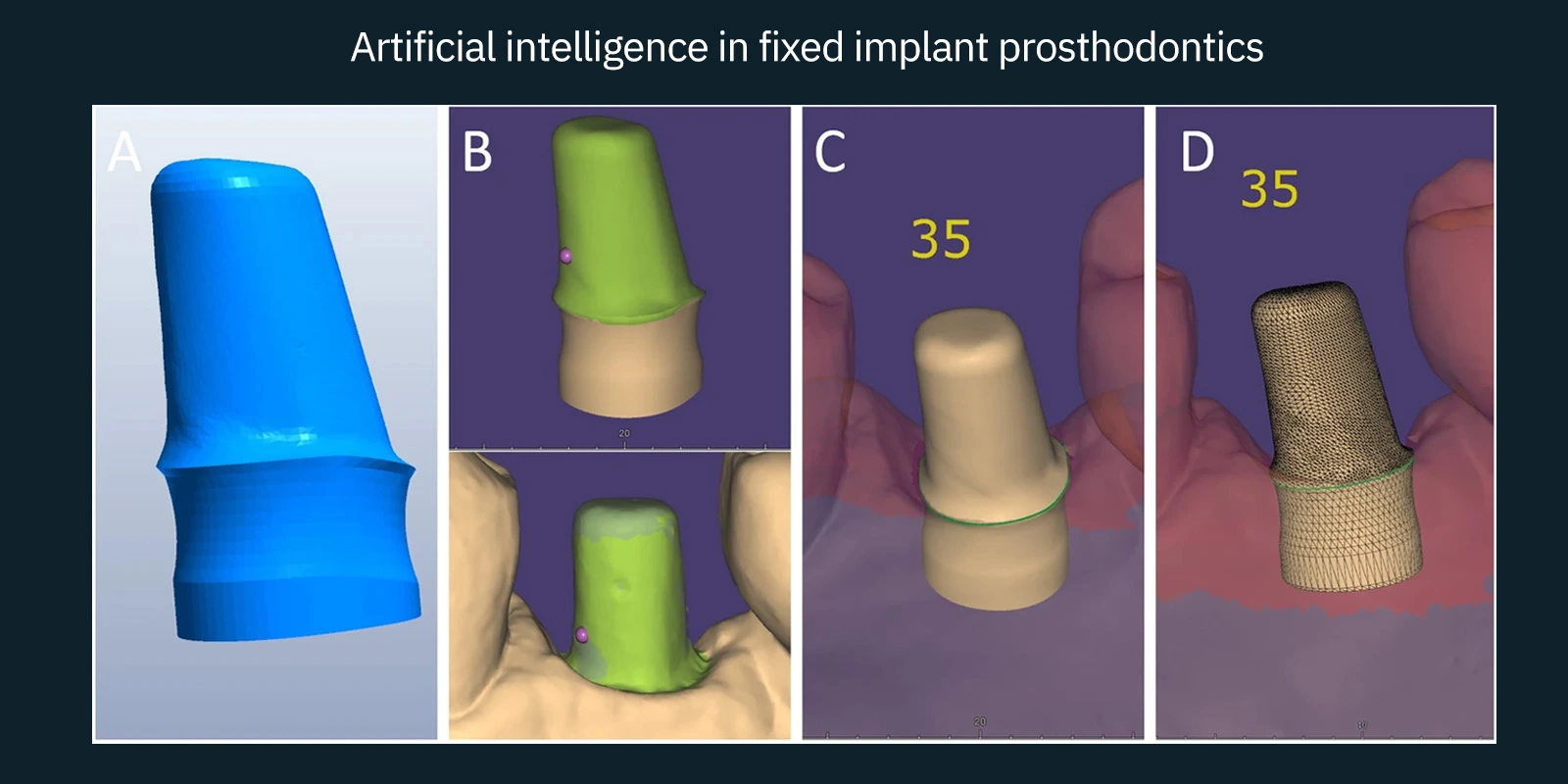 Artificial intelligence in fixed implant prosthodontics